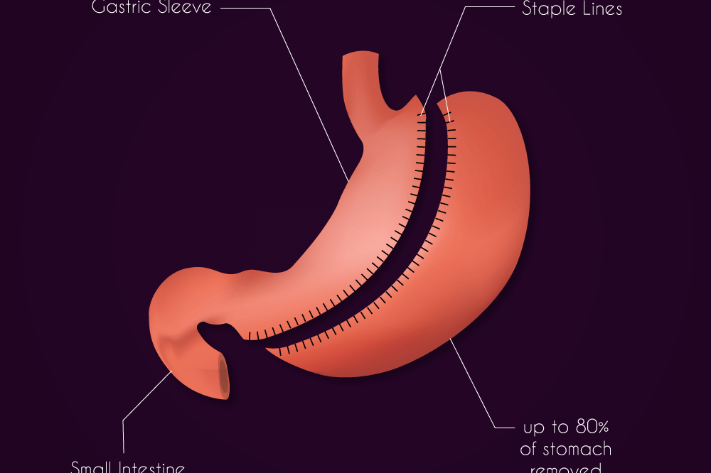 Gastric Sleeve Illustration