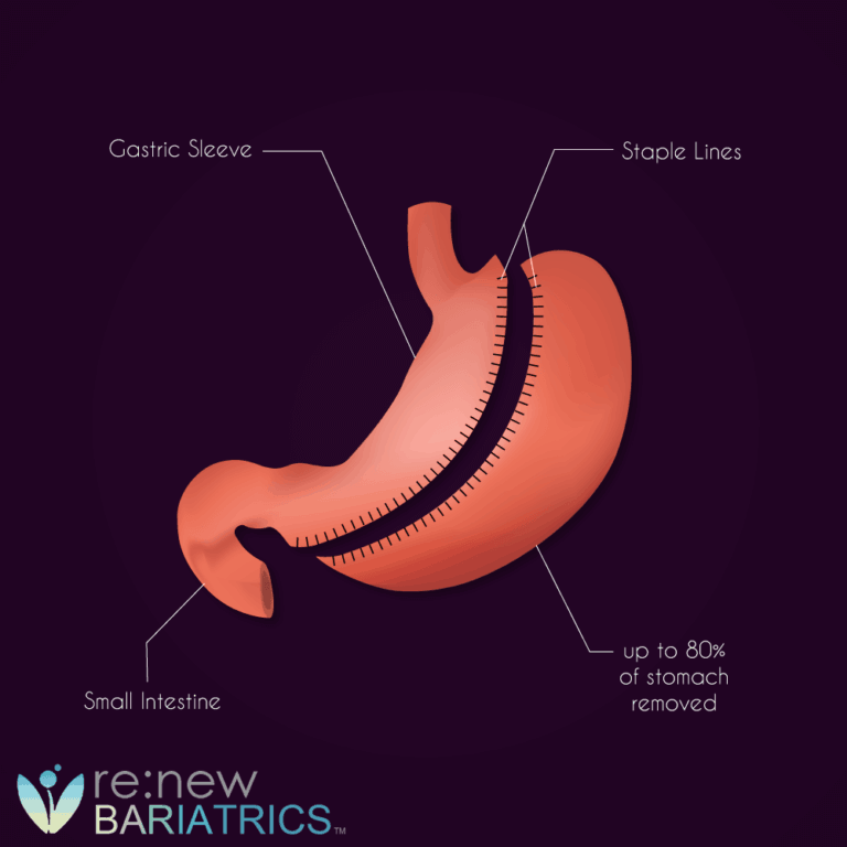 Gastric Sleeve Pouch Reset Restart the Weight Loss