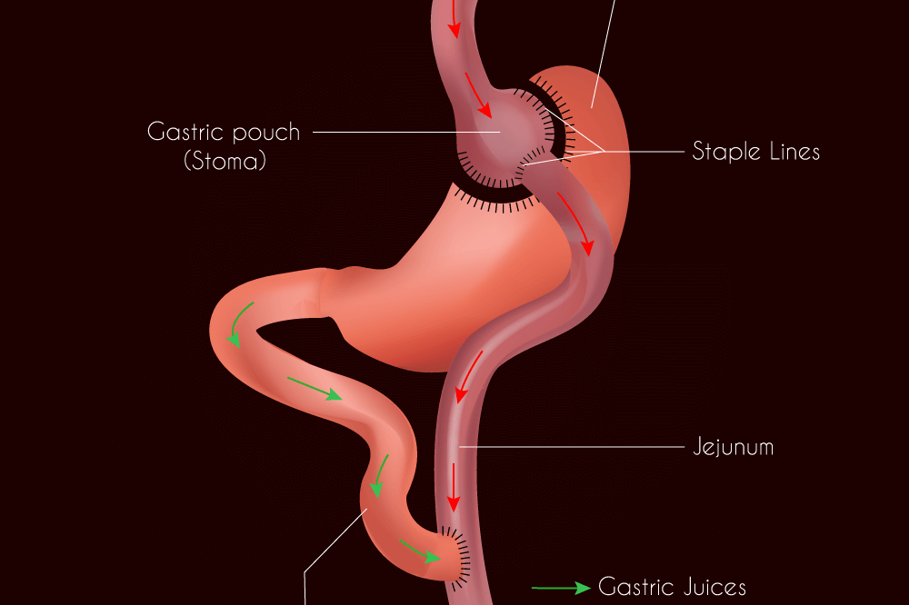 Gastric Bypass Surgery Illustration