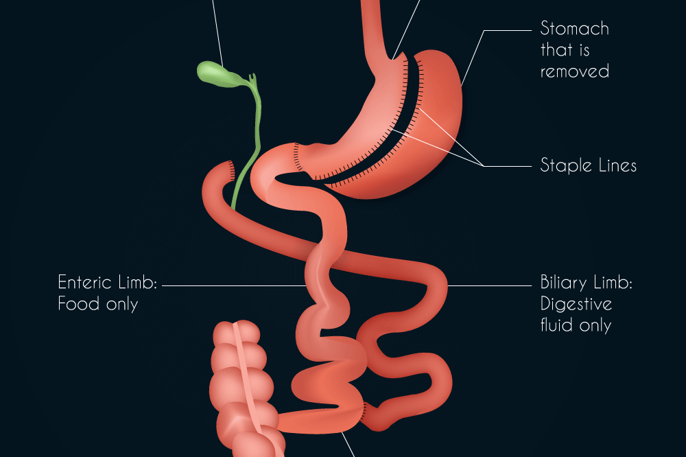 Duodenal Switch Procedure Illustraiton