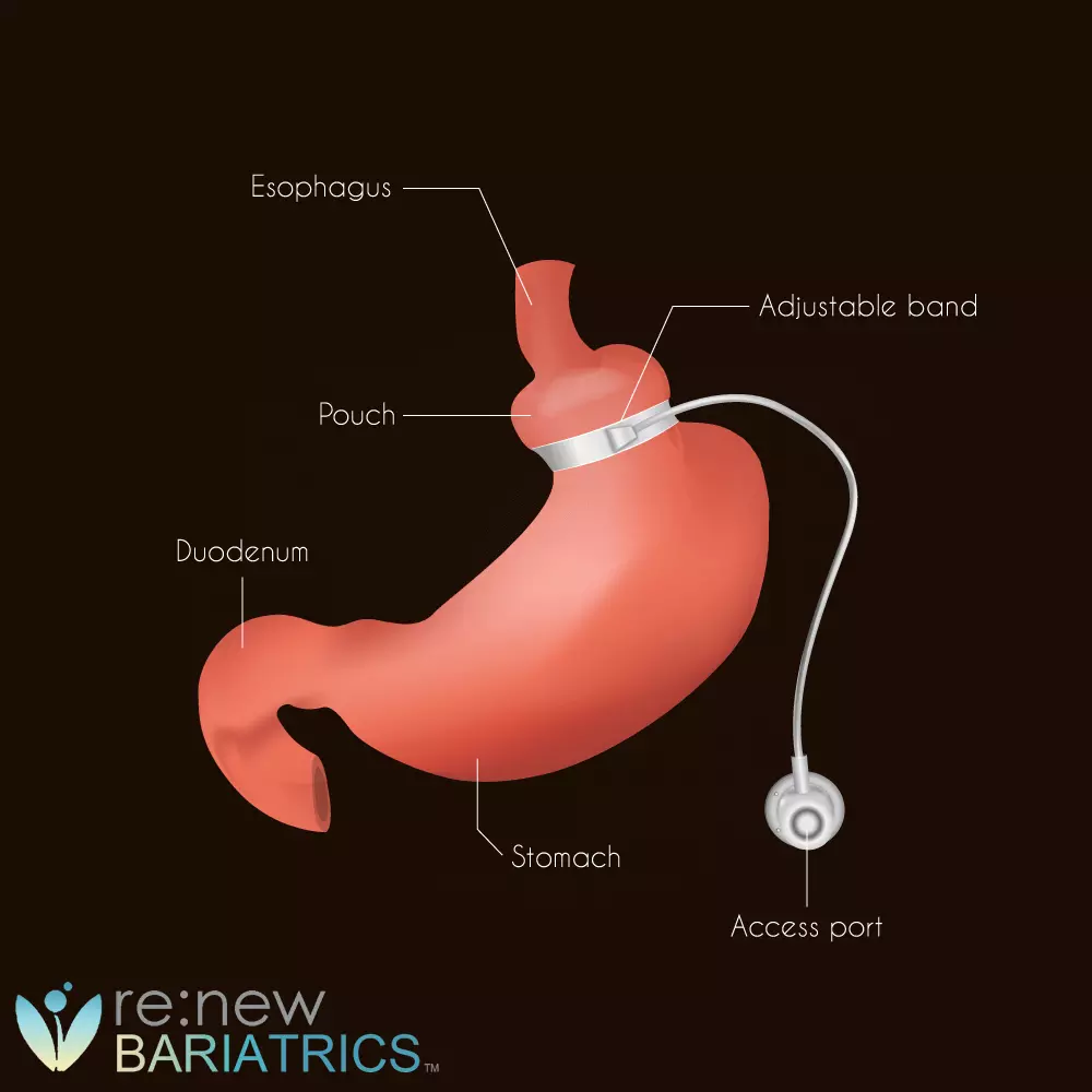 Gastric Banding Illustration