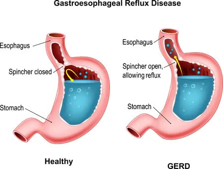 Acid reflux cause fast heart rate