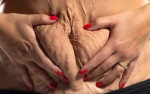 loose skin after gastric sleeve