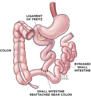 Jejunoileal Bypass