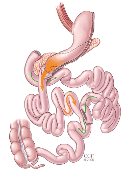 Biliopancreatic Diversion with Duodenal Switch (BPD/DS) Gastric Bypass