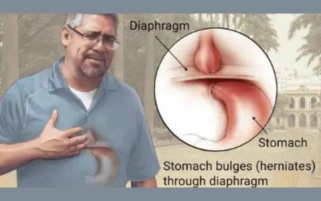 Hiatal Hernia Repair After Gastric Sleeve Renew Bariatrics