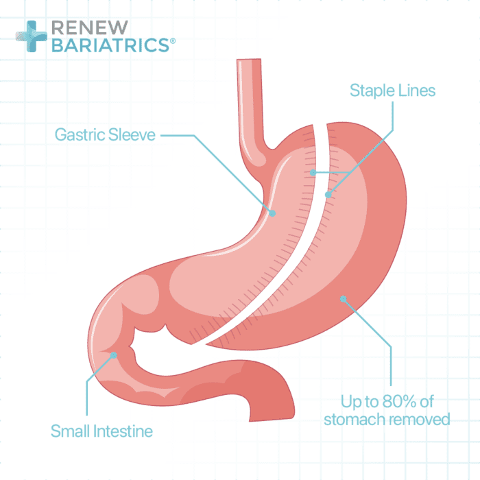 Gastric Sleeve PostOp Checklist Ensure Successful Surgery
