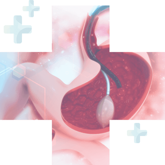 An image of a woman's stomach undergoing Gastric Sleeve Surgery (VSG) in Mexico.