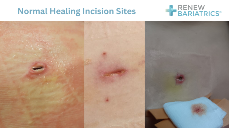 Bbl Incision Incision Care after Bariatric Surgery | Photos | Healing & Recovery