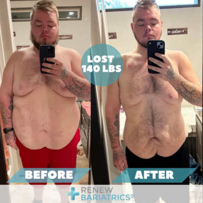 Amazing Can You Take Ibuprofen 2 Years After Gastric Sleeve Design for Mobile Amazing Can You Take Ibuprofen 2 Years After Gastric Sleeve Design for Mobile