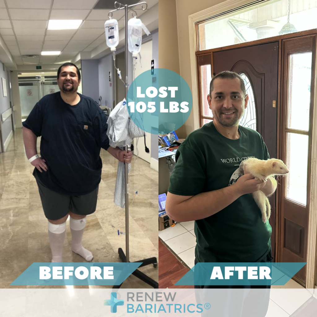 Bariatric Surgery Before and After Photos