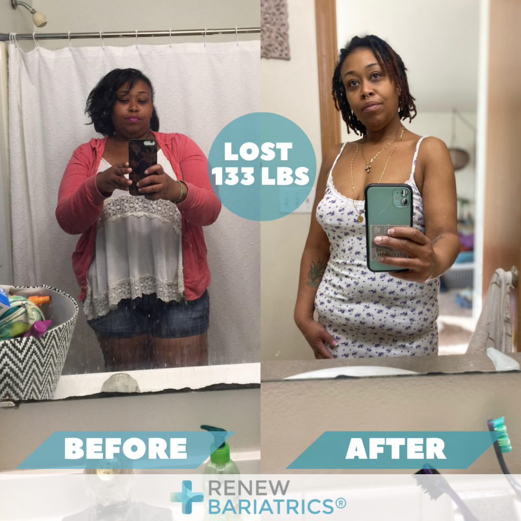 Bariatric Surgery Before and After Photos