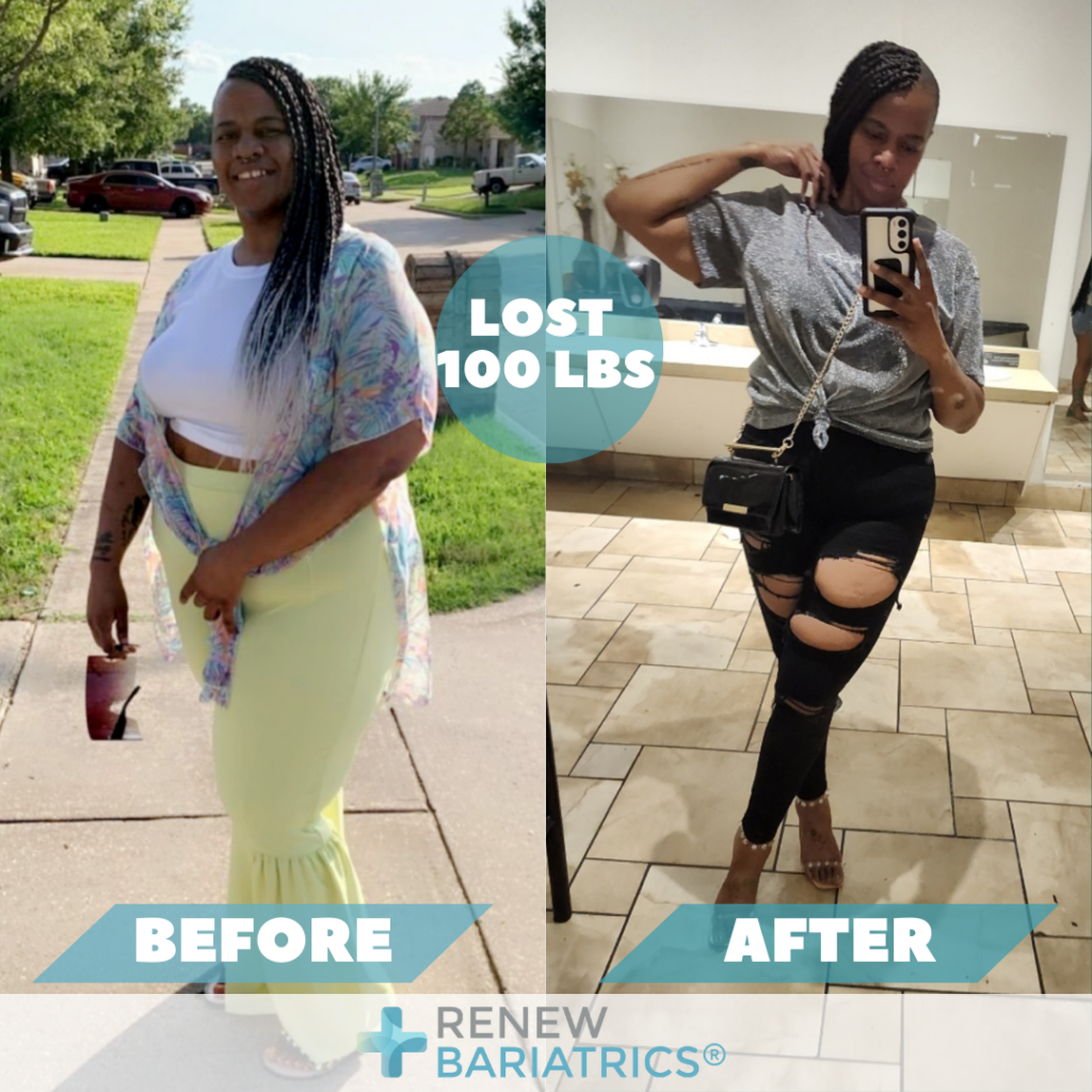 Bariatric Surgery Before and After Photos