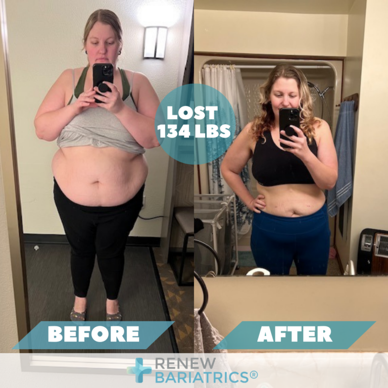 Vibrant Can You Take Ibuprofen 2 Years After Gastric Sleeve Moment Nature Vibrant Can You Take Ibuprofen 2 Years After Gastric Sleeve Moment Nature