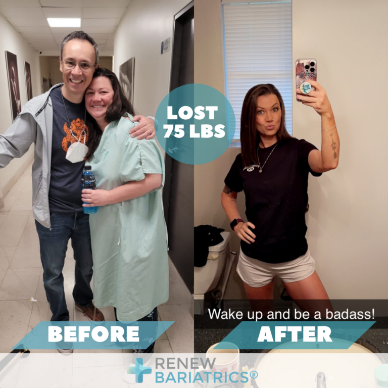 Bariatric Surgery Before and After Photos