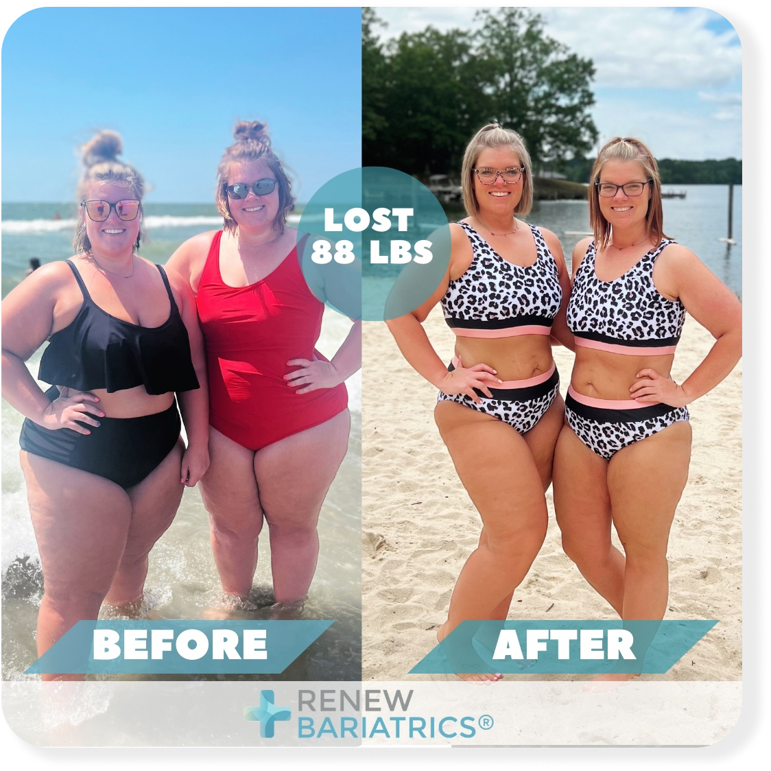 Allysan L. bariatric surgery before and after photo, lost 88 lbs