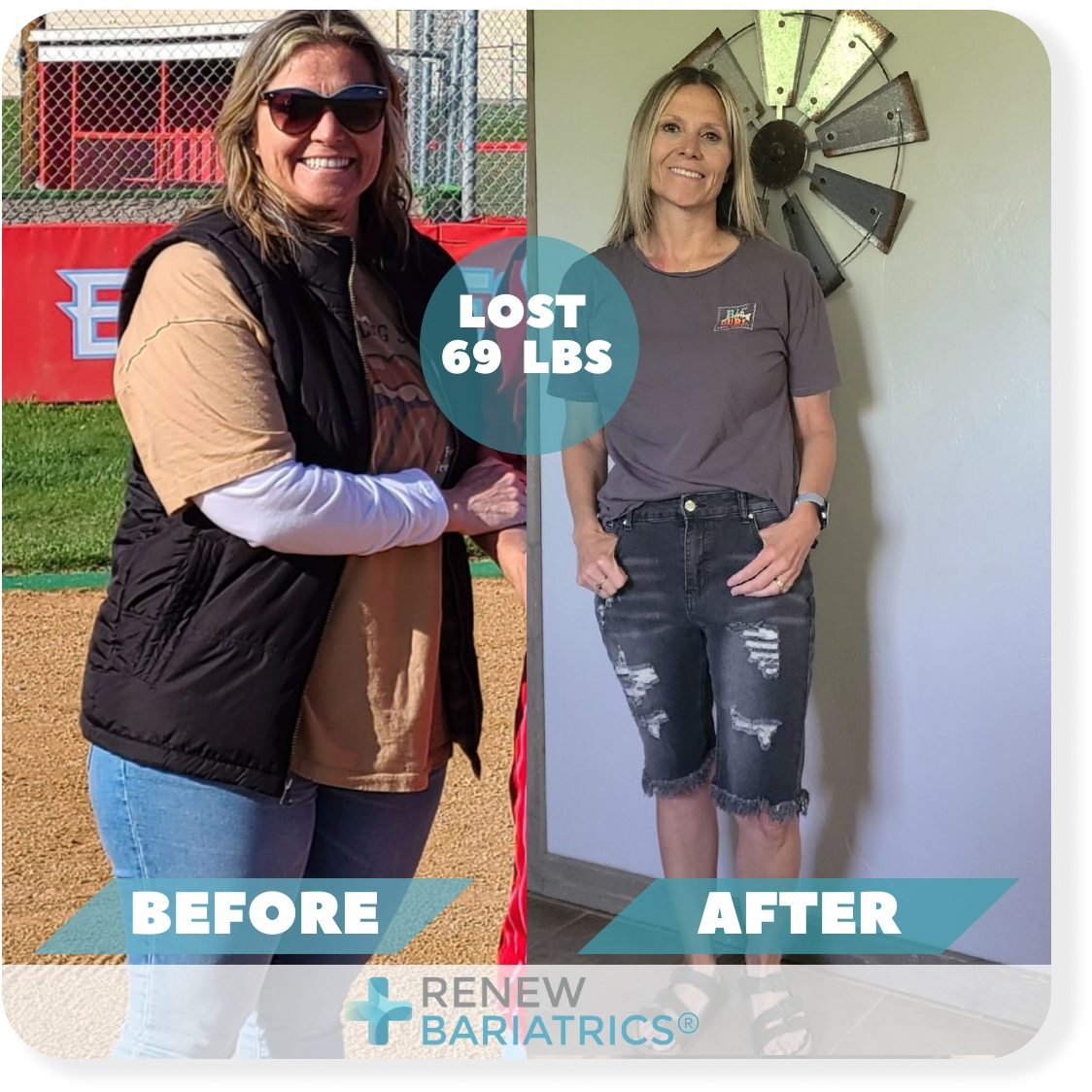 Marilyn G. bariatric surgery before and after photo, lost 69 lbs