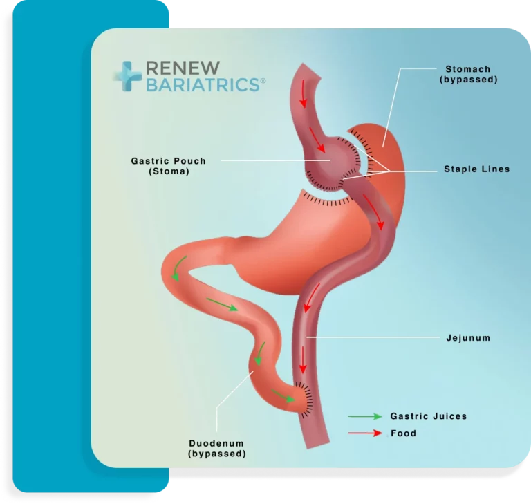 Diagram of a Roux-en-Y gastric bypass showing the small gastric pouch, the bypassed stomach and duodenum, and the jejunum