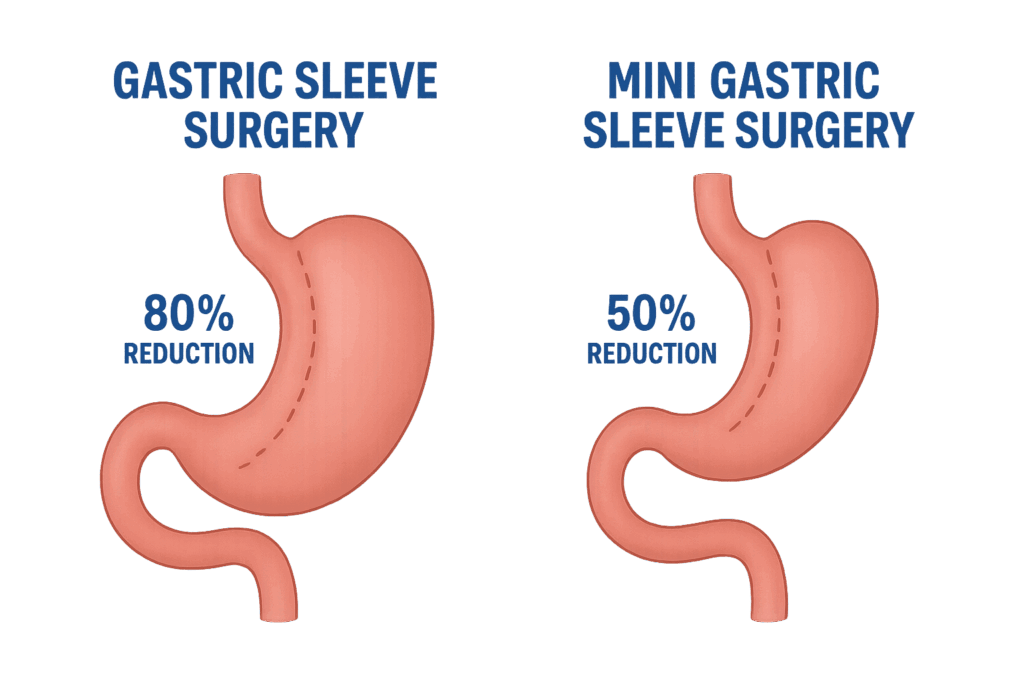 Mini Gastric Sleeve Surgery