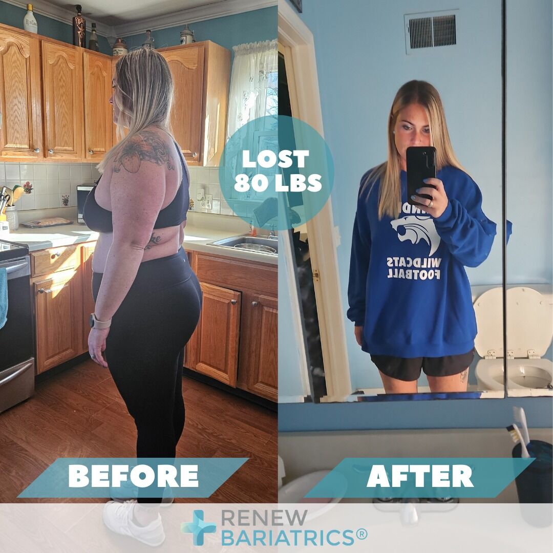 Areka S. gastric sleeve before and after photo, lost 80 lbs
