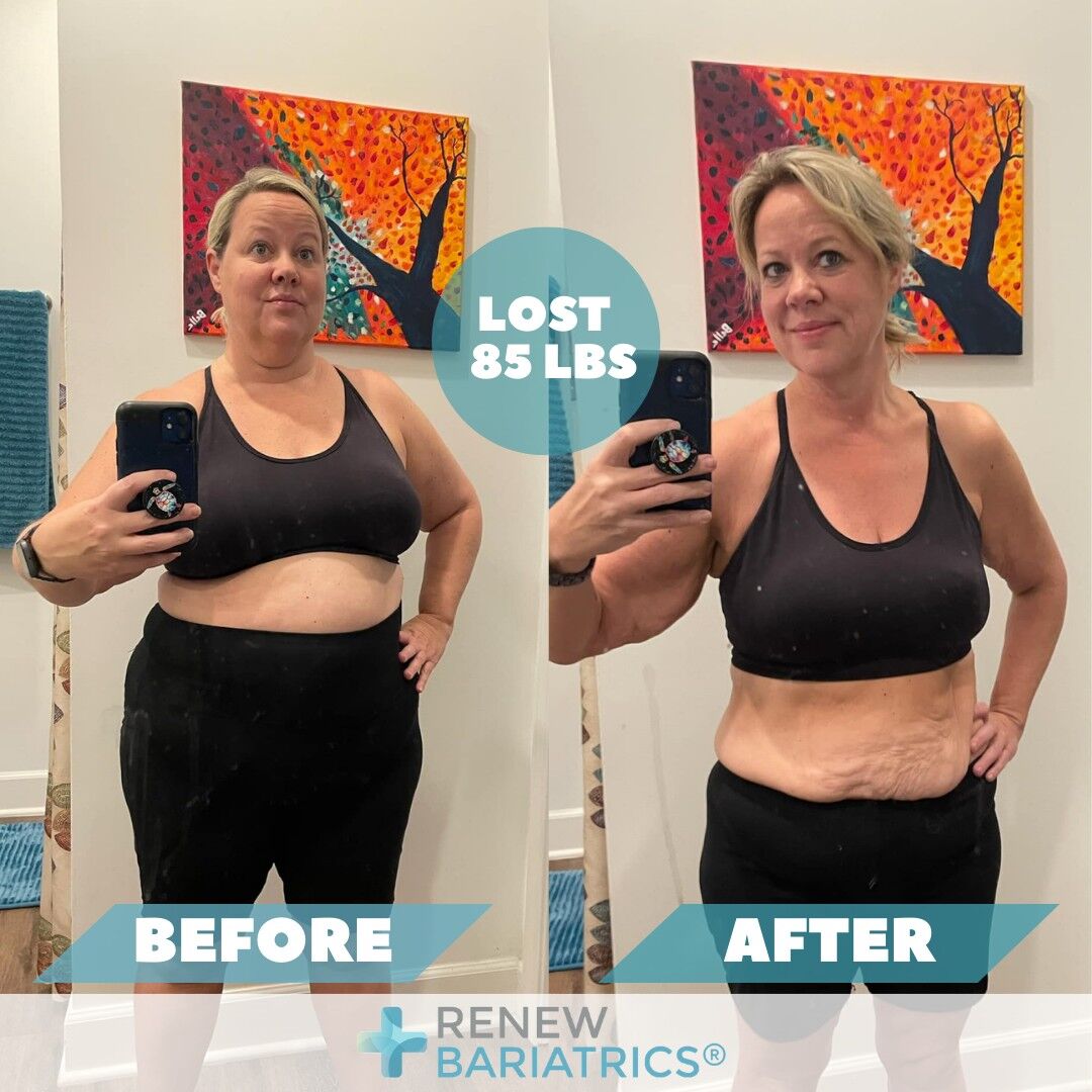 Belinda R. gastric sleeve before and after photo, lost 85 lbs