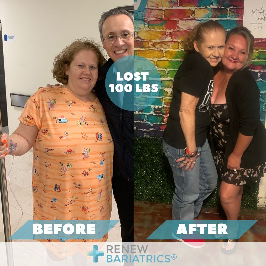 Cheryl C. gastric sleeve before and after photo, lost 100 lbs
