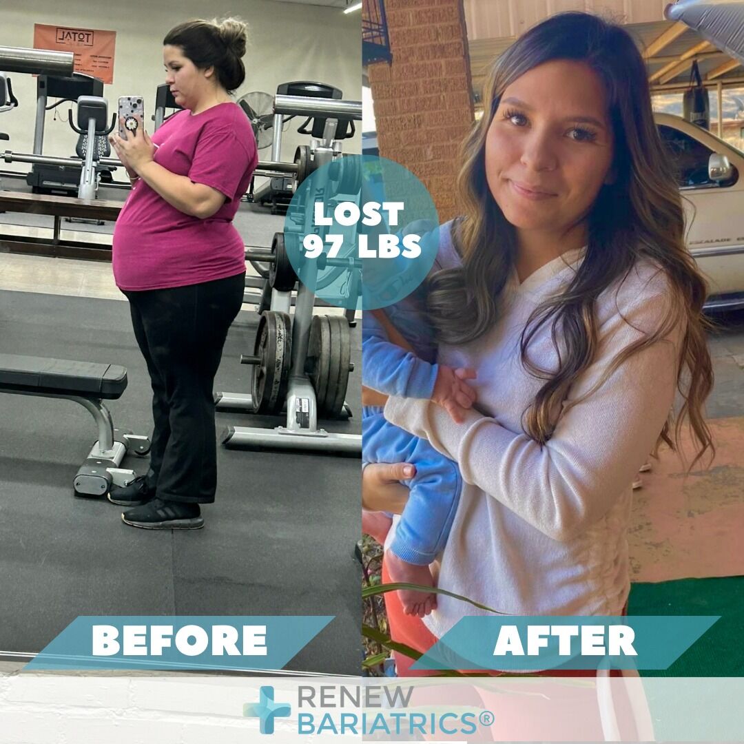 Emily W. gastric sleeve before and after photo, lost 97 lbs