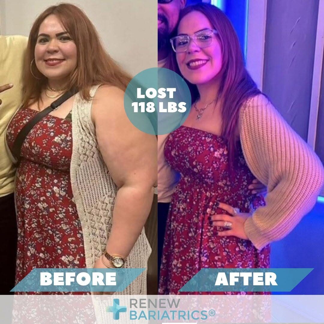 Frances G. gastric sleeve before and after photo, lost 118 lbs