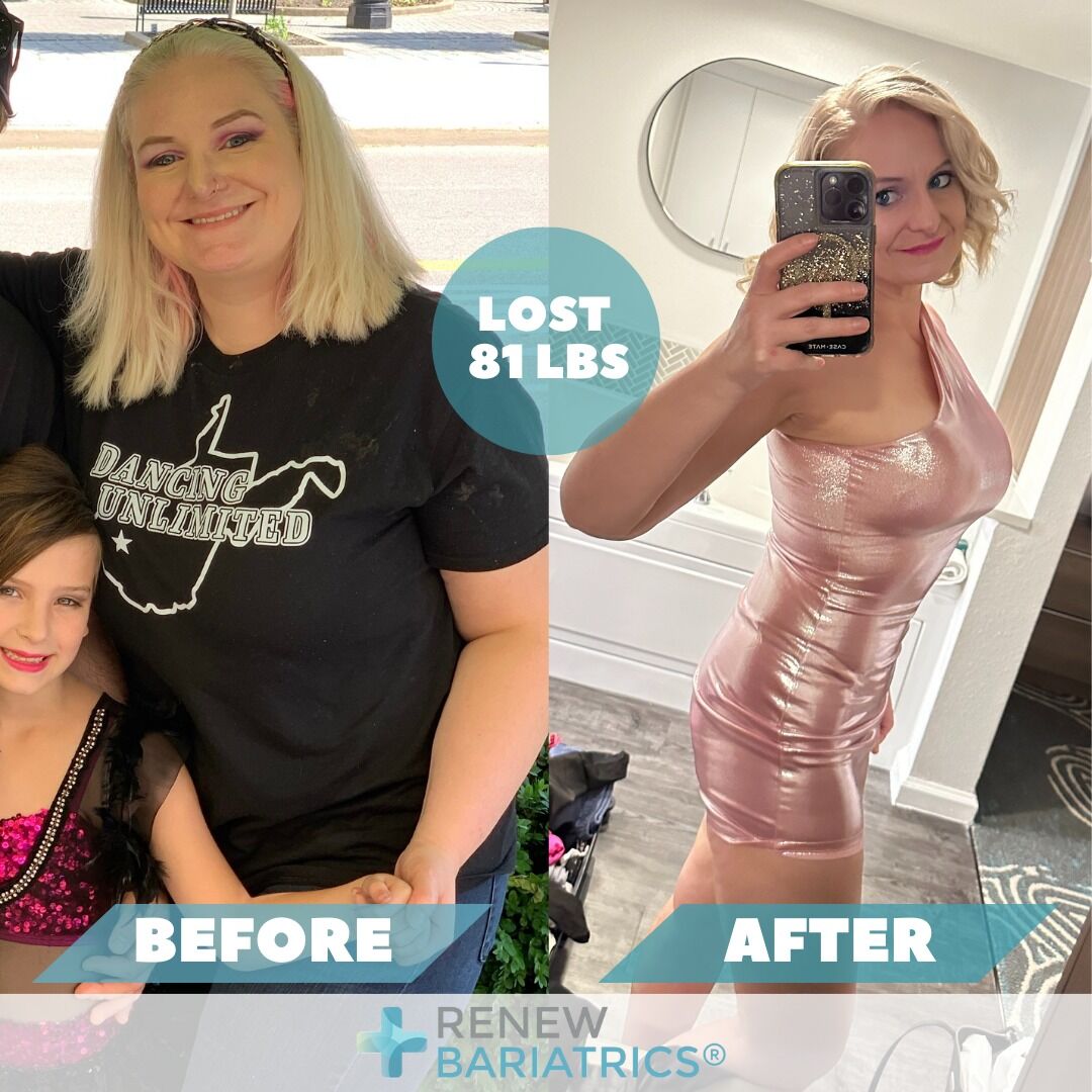 Gena B. gastric sleeve before and after photo, lost 81 lbs