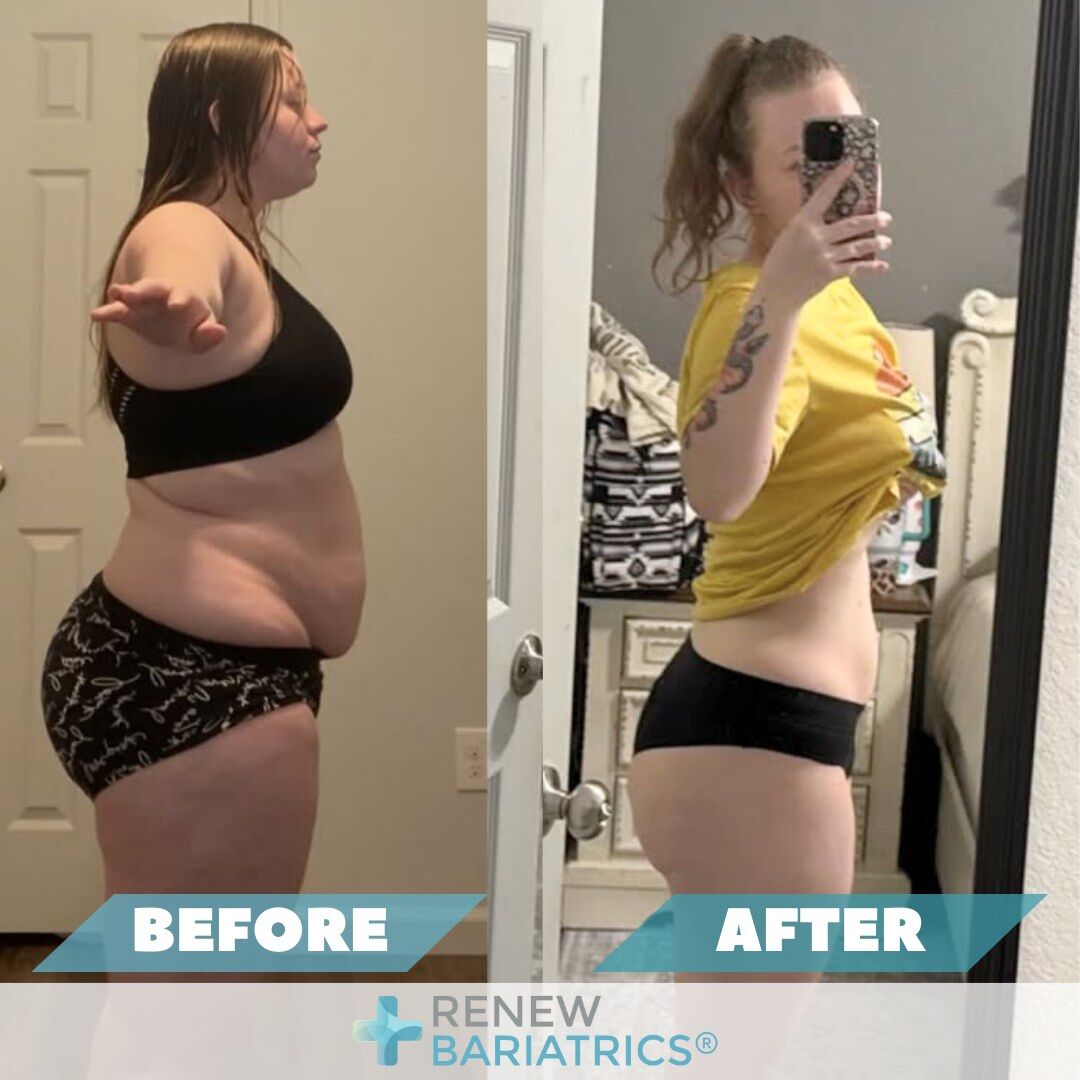 Hailey B. gastric sleeve before and after photo