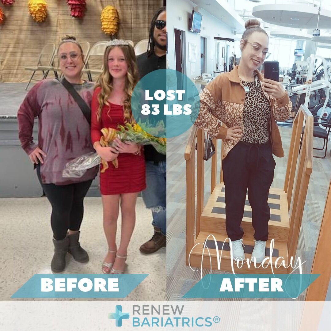 Holly M. gastric sleeve before and after photo, lost 83 lbs