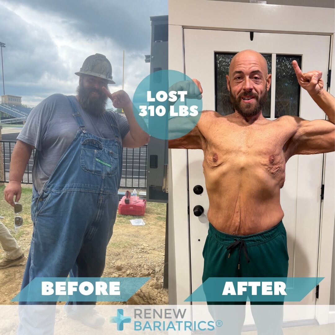 Jace M. gastric sleeve before and after photo, lost 310 lbs
