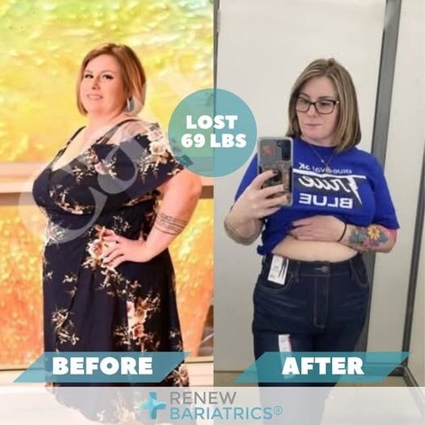 Jessica P. gastric sleeve before and after photo, lost 69 lbs