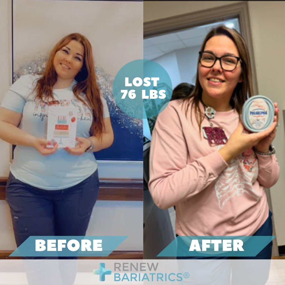 Kacee M. gastric sleeve before and after photo, lost 76 lbs