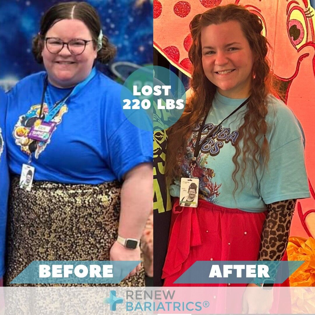 Kacie A. gastric sleeve before and after photo, lost 220 lbs