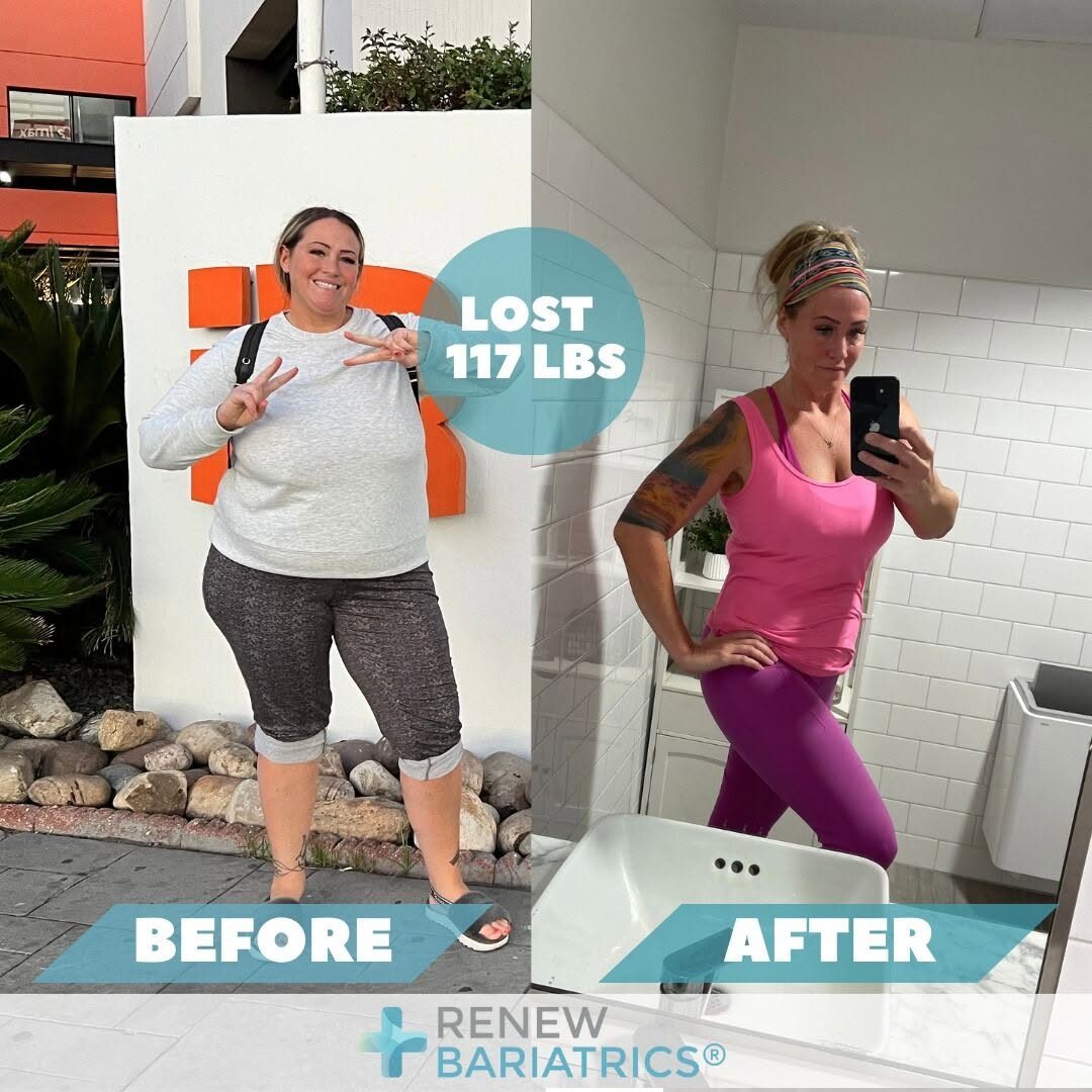 Katie B. gastric sleeve before and after photo, lost 117 lbs