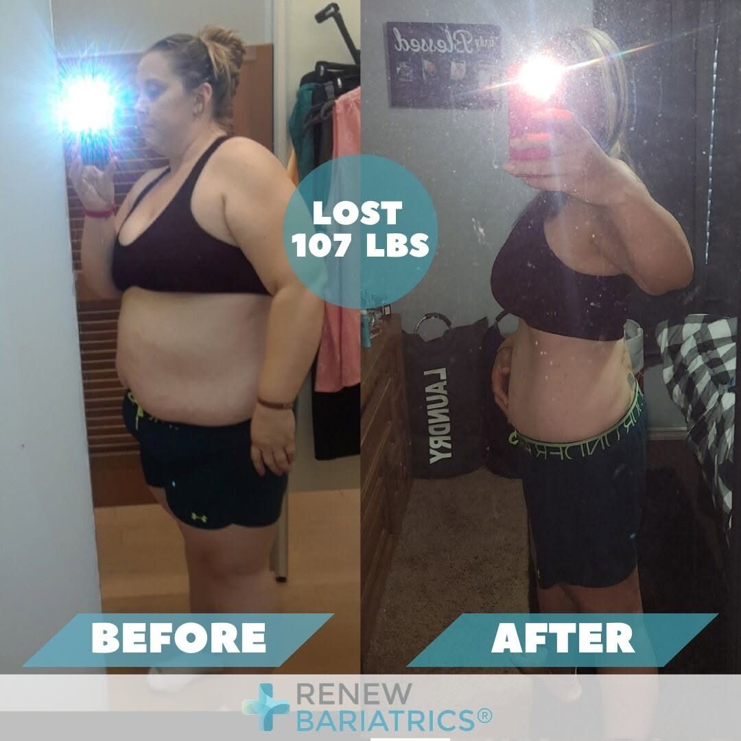 Lena S. gastric sleeve before and after photo, lost 107 lbs