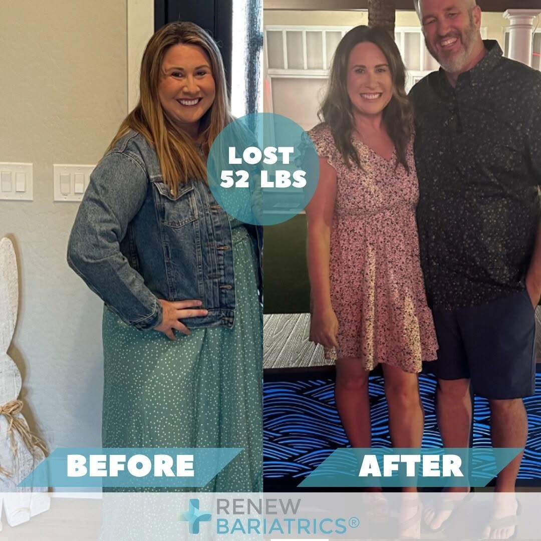 Lindsay S. gastric sleeve before and after photo, lost 52 lbs