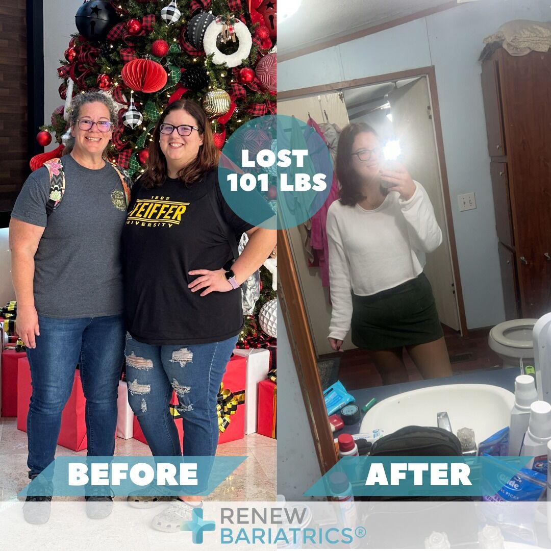 Lynzee E. gastric sleeve before and after photo, lost 101 lbs