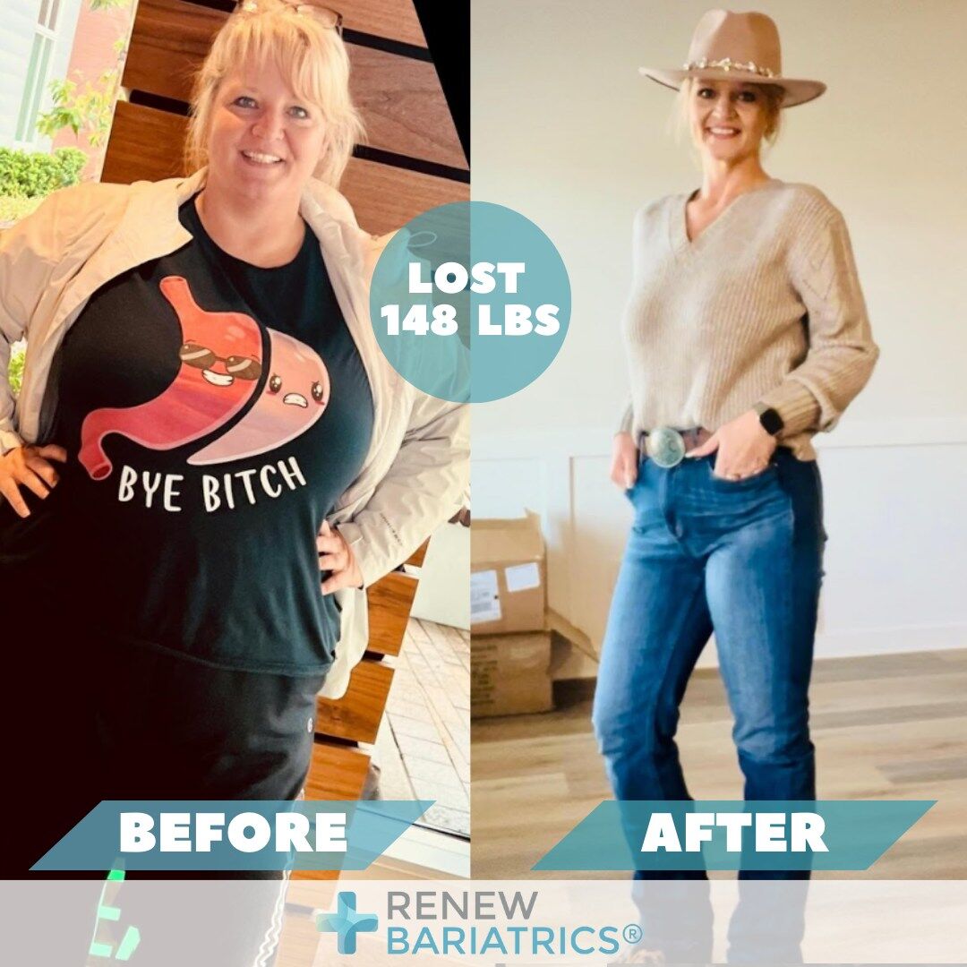 Mary M. gastric bypass before and after photo, lost 148 lbs