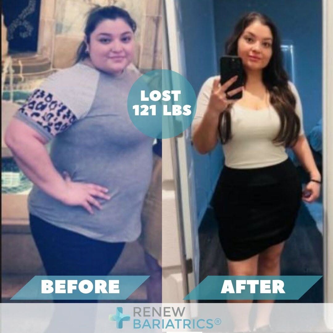 Melissa S. gastric sleeve before and after photo, lost 121 lbs