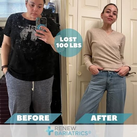 Michelle B. gastric sleeve before and after photo, lost 101 lbs