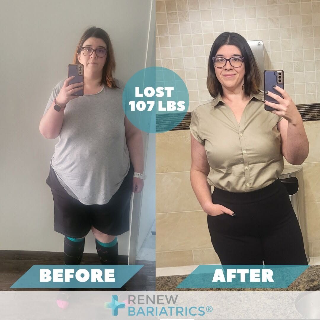 Morgan K. gastric sleeve before and after photo, lost 107 lbs