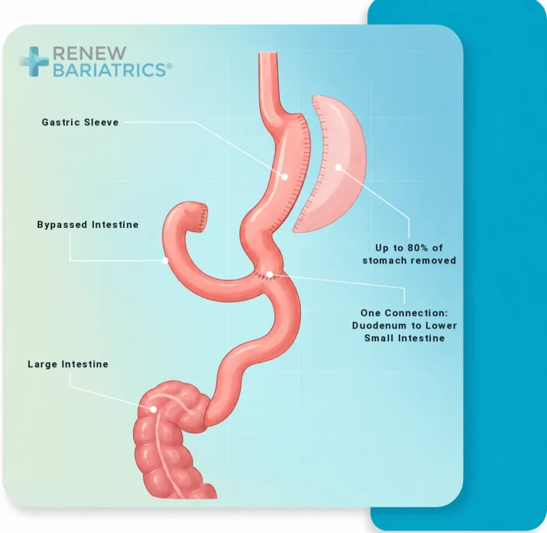 Illustration of SADI-S: a sleeve-shaped stomach connected to a loop of small intestine just past the pylorus