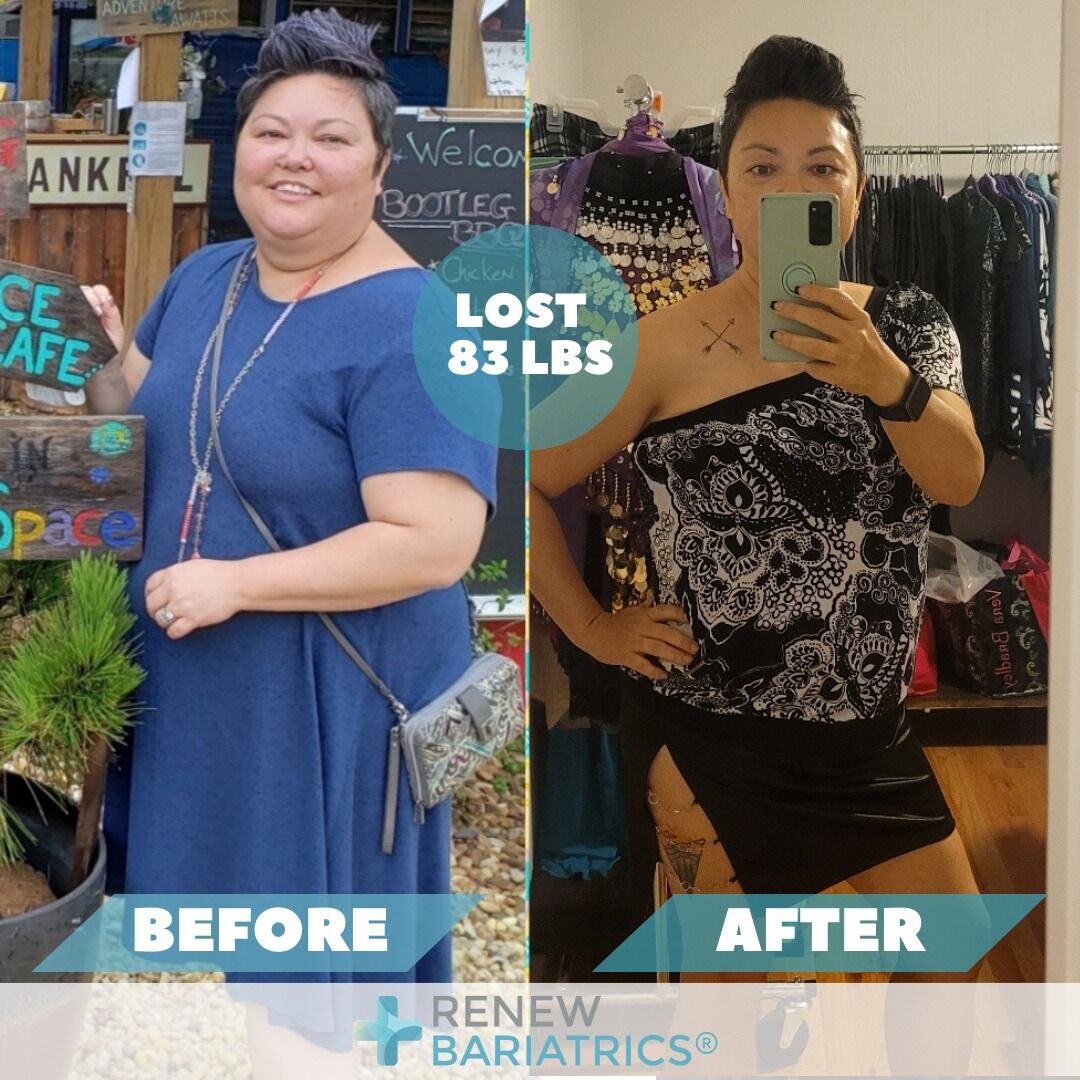 Tara H. gastric sleeve before and after photo, lost 83 lbs