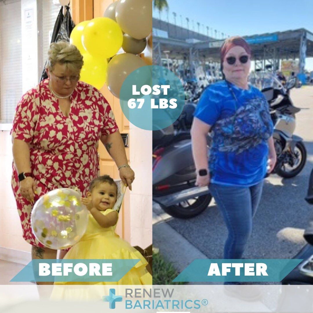 Wanda M. gastric sleeve before and after photo, lost 67 lbs